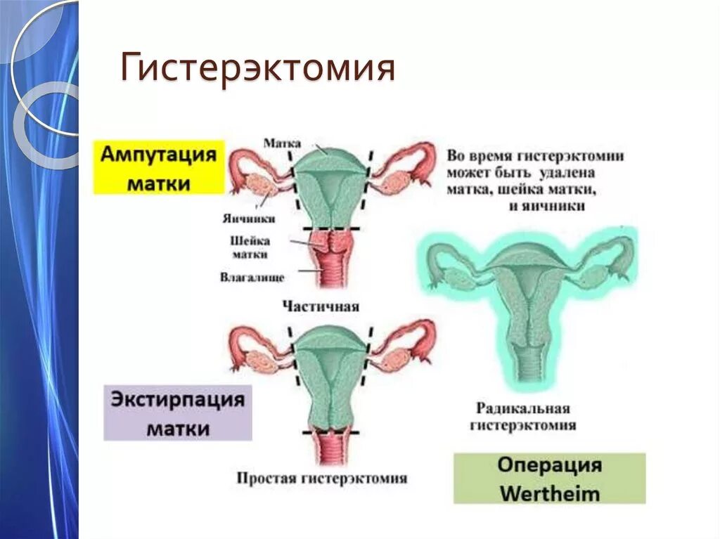 Гистерэктомия что это такое простыми. Гистерэктомия классификация. влагалищная экстирпация матки. тотальная экстирпация матки с придатками.