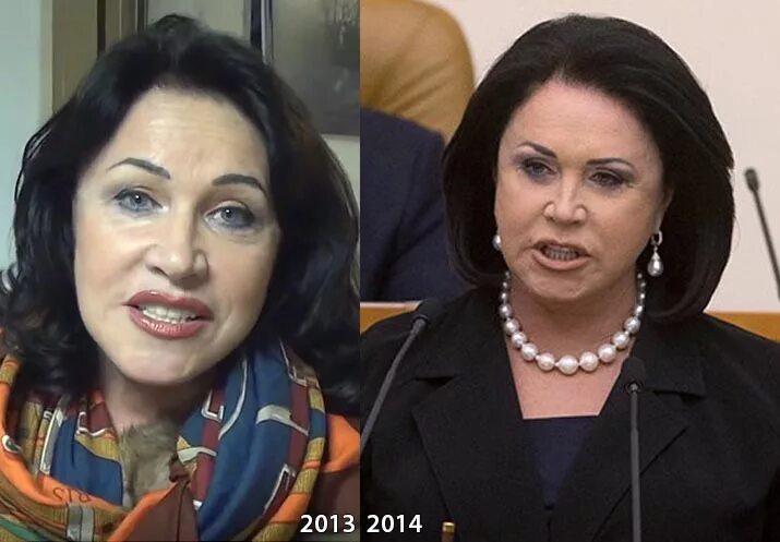 Бабкина надежда пластика 2021. Надежда бабкина пластика 2023. Бабкина после пластики последние. Надежда бабкина до операции. Надежда бабкина до пластики.