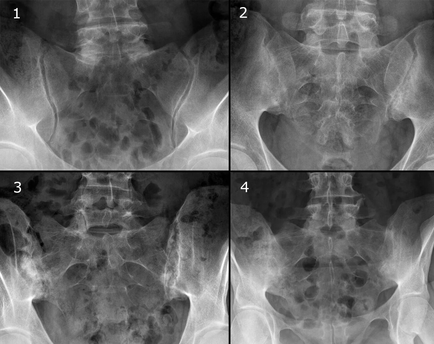 Болезнь Бехтерева сакроилеит. Анкилозирующий сакроилеит рентген. Сакроилеит крестцово-подвздошного сочленения рентген. Сакроилеит рентген стадии.