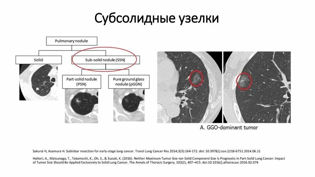 Субсолидные очаги в легких