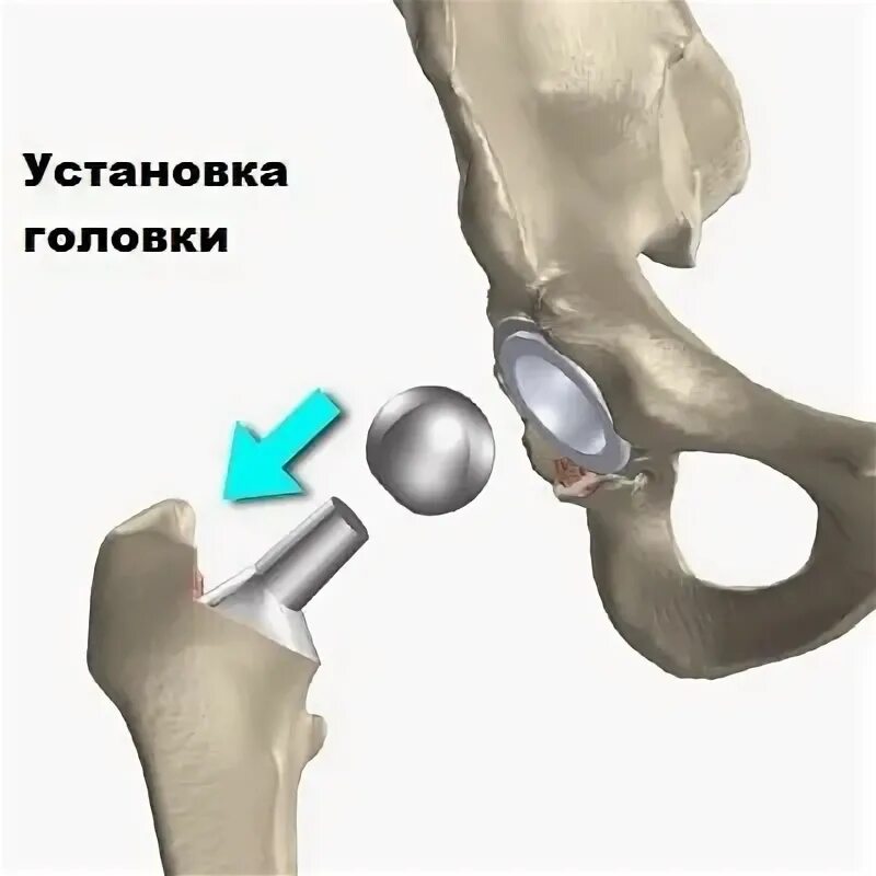 Перелом шейки бедра операция. Эндопротез тазобедренного сустава перелом шейка. Перелом шейки бедра эндопротезирование. Перелом шейки бедра эндопротезирование тазобедренного сустава. Врач шейка бедра