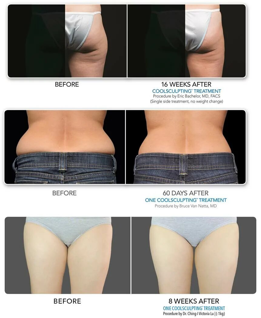 After weeks. Thigh gap before after. кулскалптинг после кесарева отзывы.