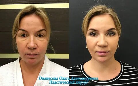 Операция убрать малярные мешки