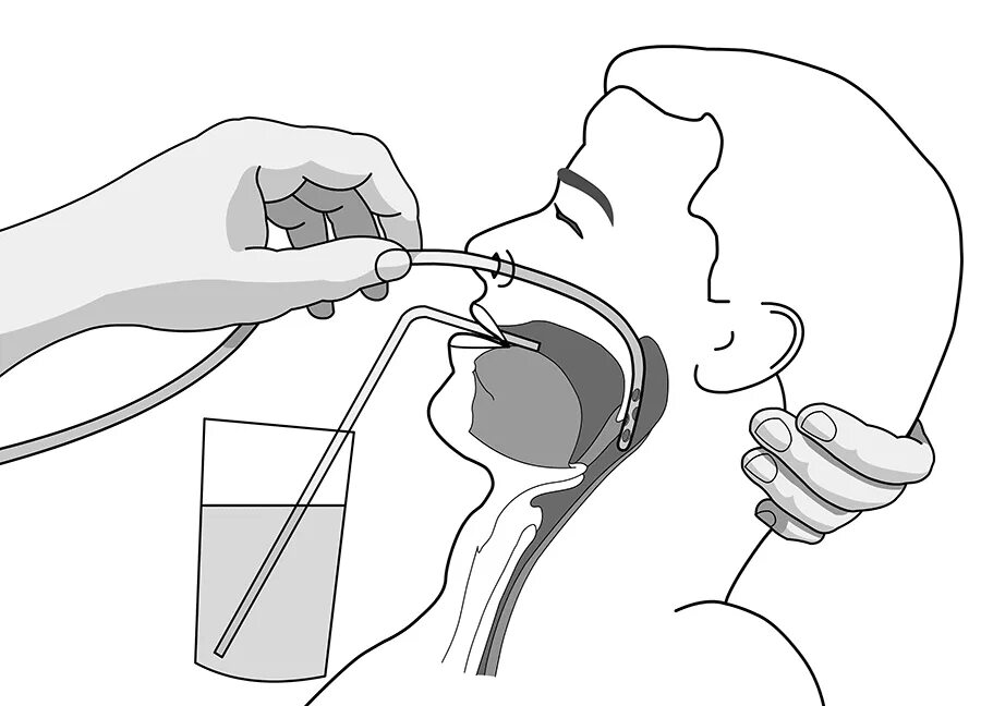 Трубка через рот. Назогастральный зонд промывание алгоритм. Введение назогастрального зонда алгоритм. Постановка эпигостралоного зонта. Назогастральный зонд промывание желудка.