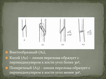Винтообразный перелом
