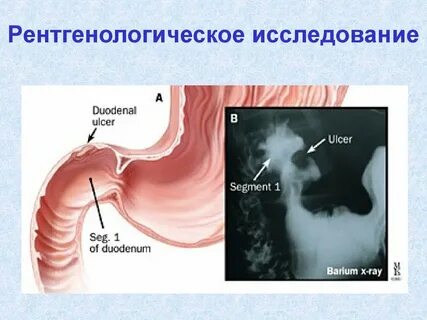 Язва признаки