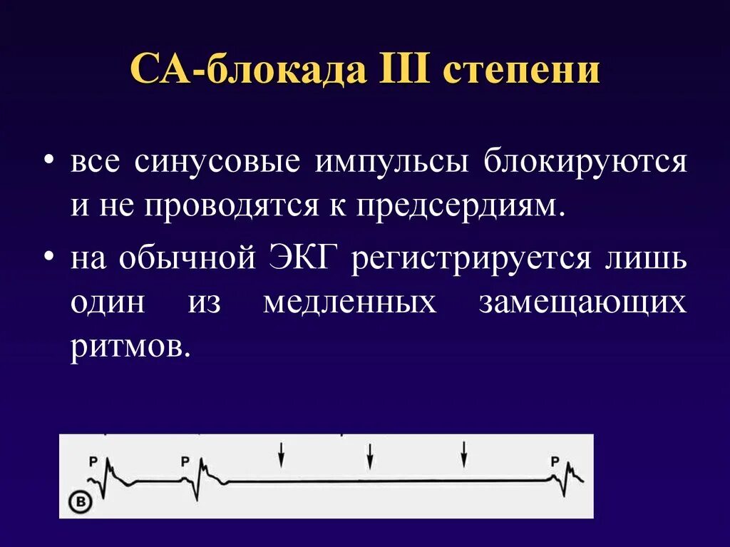 Системами блокада. Синоатриальная блокада 2 степени 3:2. Синоатриальная блокада Мобитц 1 ЭКГ. Са блокада 1 степени на ЭКГ признаки. Са блокада 3 степени признаки на ЭКГ.