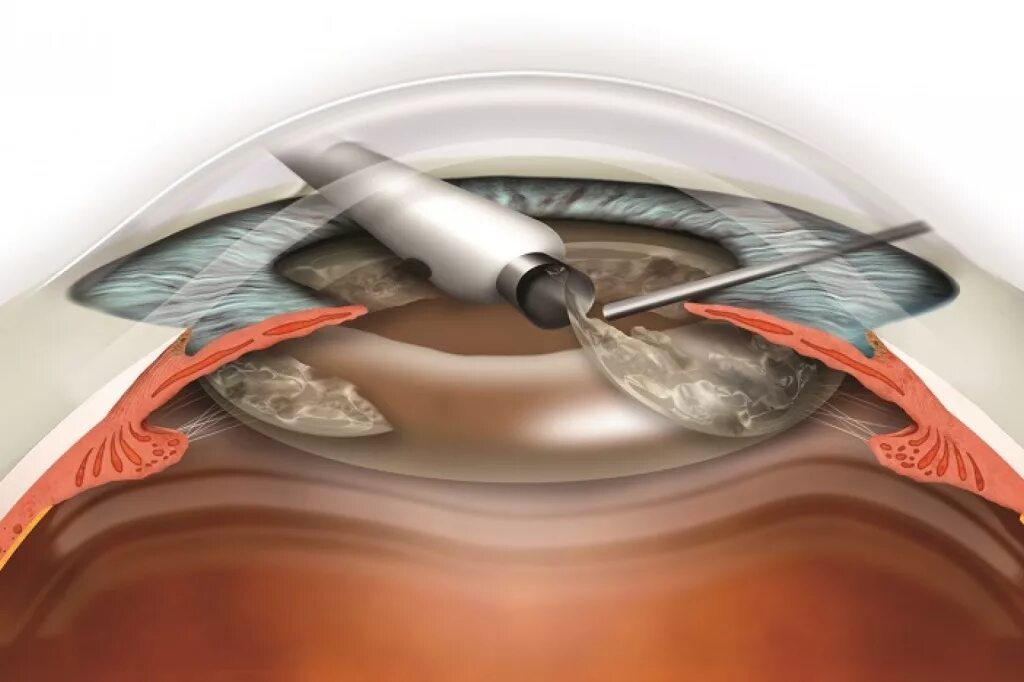 Операция факоэмульсификация катаракты. Операция ультразвуковая факоэмульсификация катаракты. Ультразвуковая факоэмульсификация с имплантацией ИОЛ. Ультразвуковая факоэмульсификация катаракты ход операции. Действие после операции катаракта