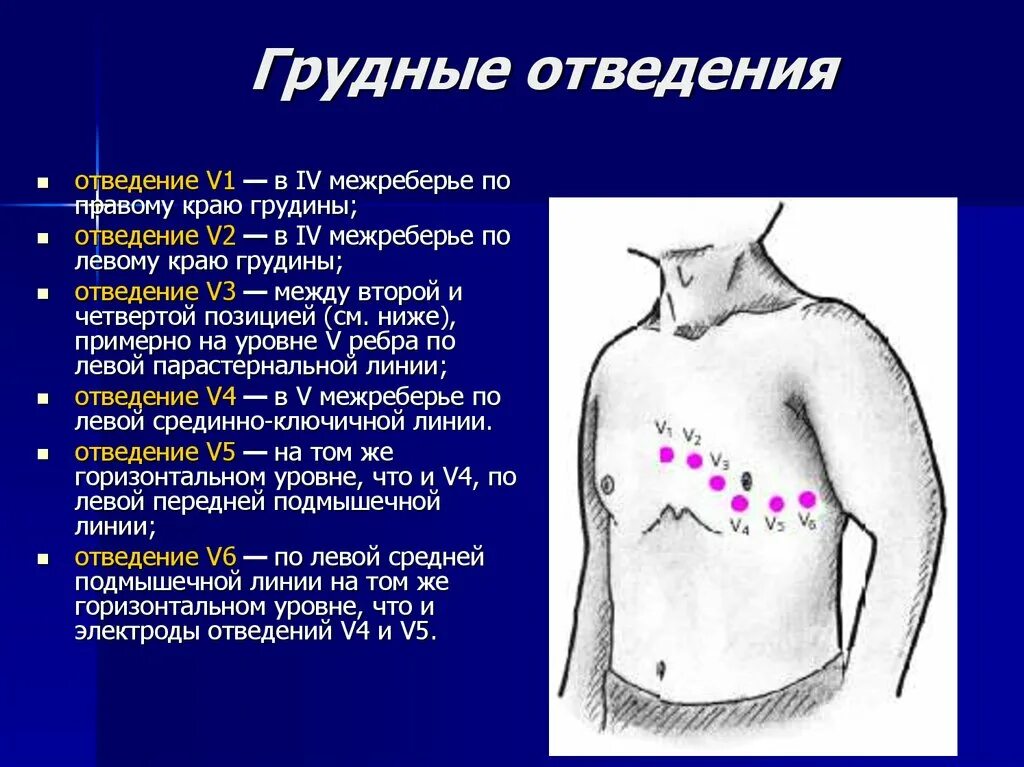 Стандартные и грудные отведения в ЭКГ. Отведения ЭКГ грудные отведения. 6 Грудных отведений ЭКГ. Правые грудные отведения v4r. Правые грудные отведения