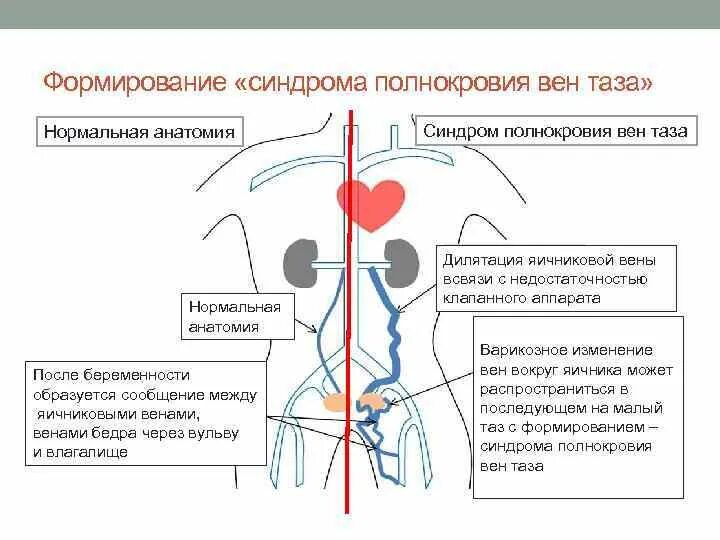 Венозный застой крови. Варикоз вен малого таза. Расширение вен малого таза. Варикозное расширение вен малого таза симптомы.