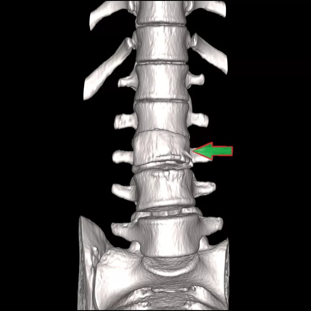 Компрессионный перелом th6. Компрессионные переломы l2,l3,l4. Компрессионный перелом позвоночника кт. Компрессионный перелом позвоночника l5.