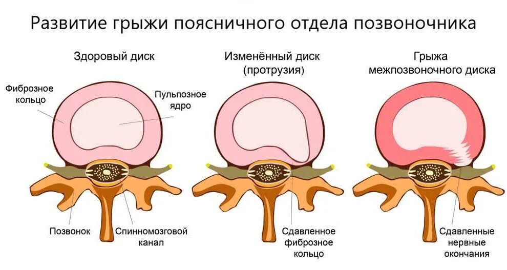 Протрузия шейного отдела позвоночника симптомы. Разрыв фиброзного кольца межпозвоночного диска. Грыжа межпозвоночного диска разрыв фиброзного кольца. Протрузия межпозвонковых дисков 1,4 1.5. Грыжа диска и протрузия диска.