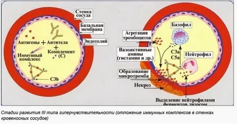 Повреждение иммунными комплексами