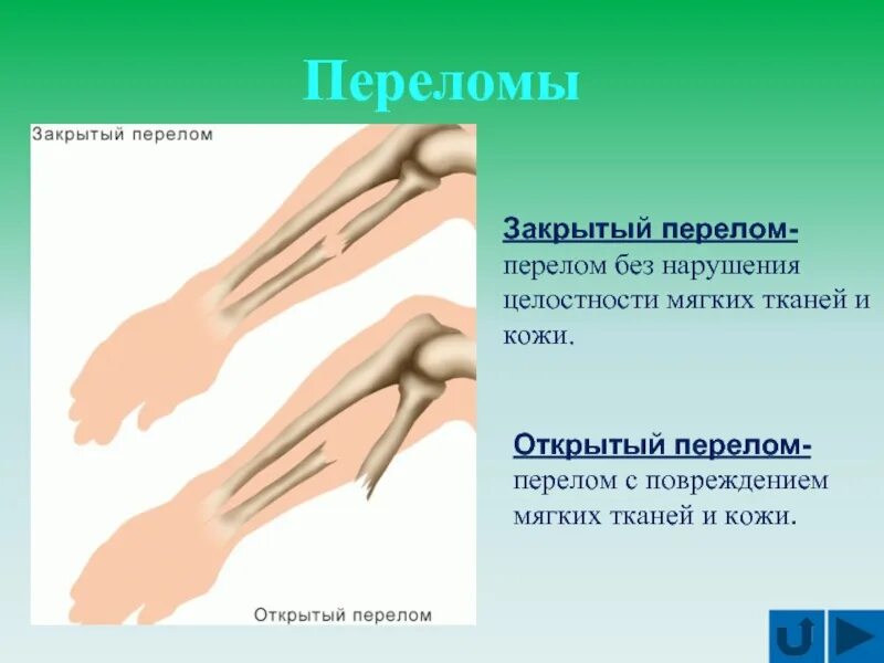 Разрыв кости. Открытые и закрытые переломы. Открытые и закрытые передома. Открытый перелом и закрытый перелом.