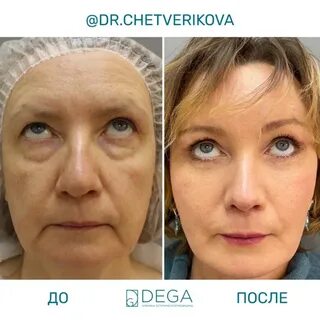Ботокс и смас