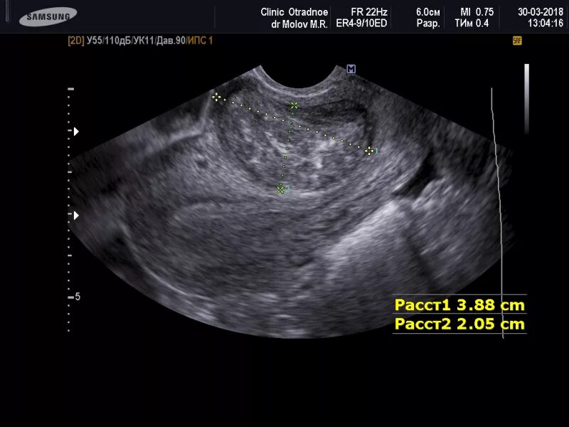Миома матки малых размеров на УЗИ. Миома и беременность на УЗИ. На узи видно рак шейки