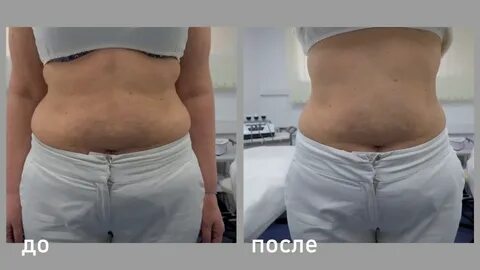 Кавитация фото после процедуры