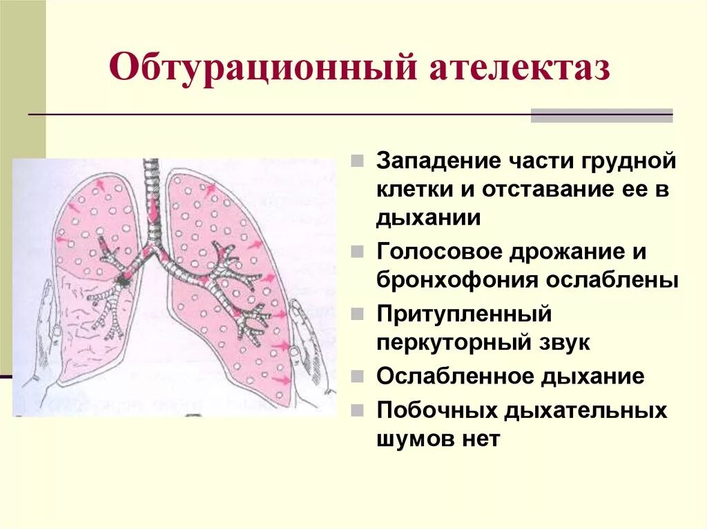 Звук в легких при дыхании. Сегментарный ателектаз. Обтурационный ателектаз. Обтуратозный ателекзат. Обтурационный ателектаз легкого.