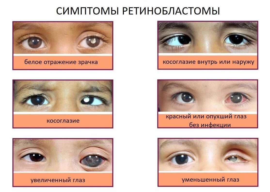 Симптом кошачьего глаза ретинобластома. Ретинобластома 4 стадия. Симптомы ретинобластома ранние. Опухоли глаза классификация.