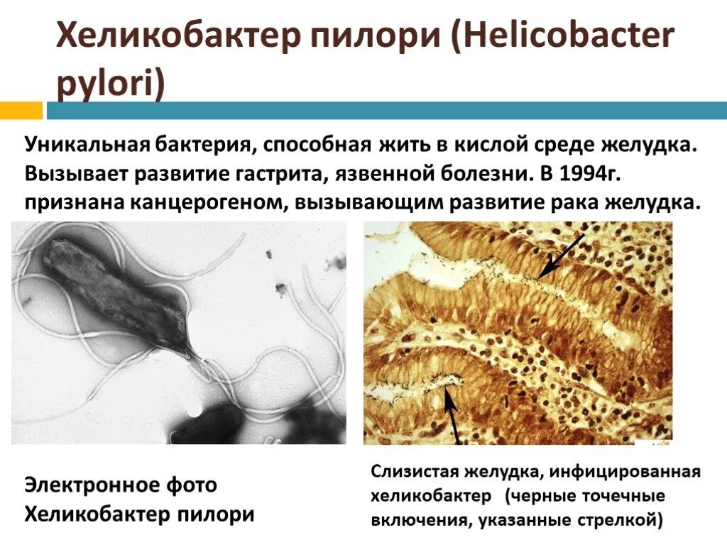 Причины появления хеликобактера. Язвенная болезнь желудка хеликобактер. Пилори хеликобактер спирохеты. Бактериальная инфекция хеликобактер пилори. Хеликобактер пилори язвенная болезнь.