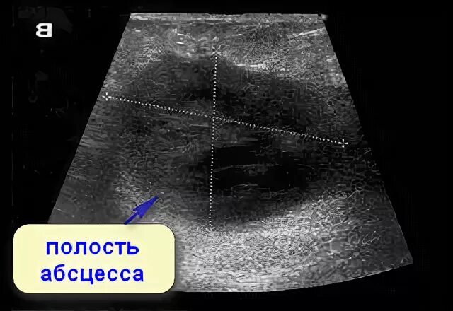 Абсцесс железы