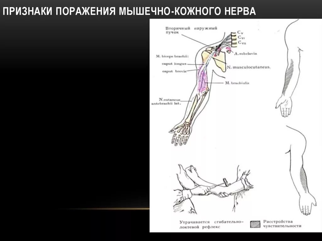 Кожно нервные. Поражение кожно-мышечного нерва проявляется:. Поражение мышечно-кожного нерва симптомы. Повреждение мышечно кожного нерва симптомы. Признаки поражения мышечно-кожного нерва.