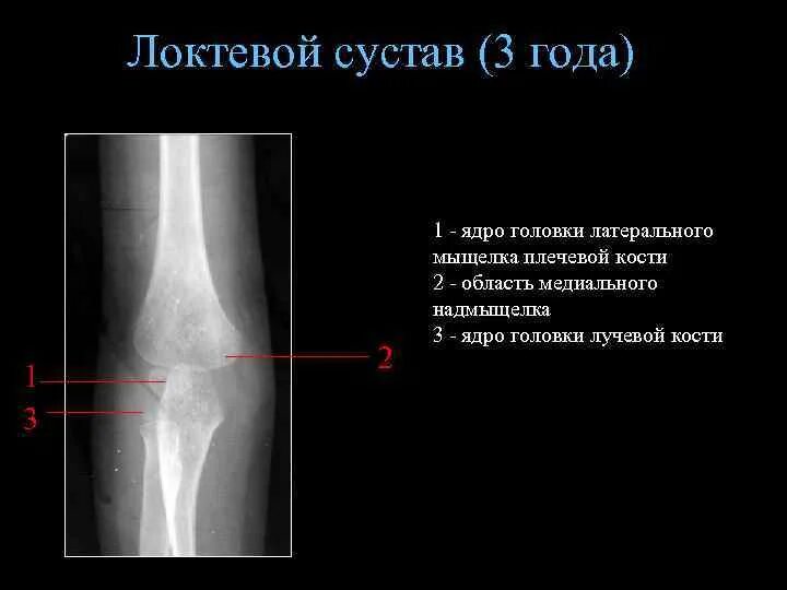 Эпифизеолиз медиального надмыщелка плеч. Головка латерального мыщелка плечевой кости. Эпифизеолиз мыщелка плечевой кости. Эпифизеолиз медиального надмыщелка плечевой кости.