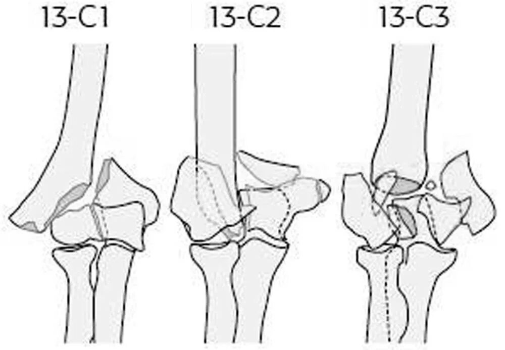 Внутрисуставной перелом мыщелка. Внутрисуставной чрезмыщелковый перелом плечевой кости. Плечевая кость чрезмыщелковый перелом. Перелом мыщелка плечевой кости у детей. Чрезмыщелковый перелом плечевой кости у детей.