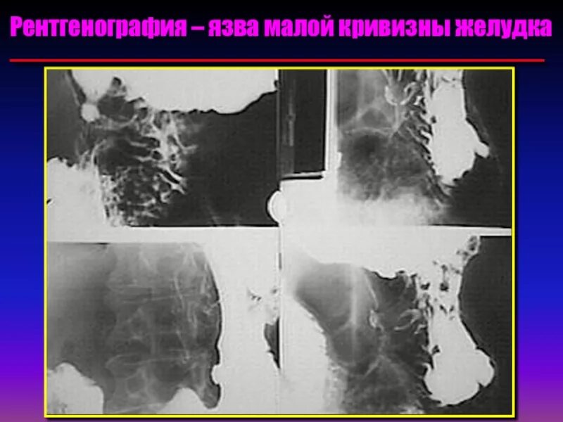 Малигнизация желудка рентген. Двойное контрастирование желудка рентген. Малигнизация язвы желудка рентген.