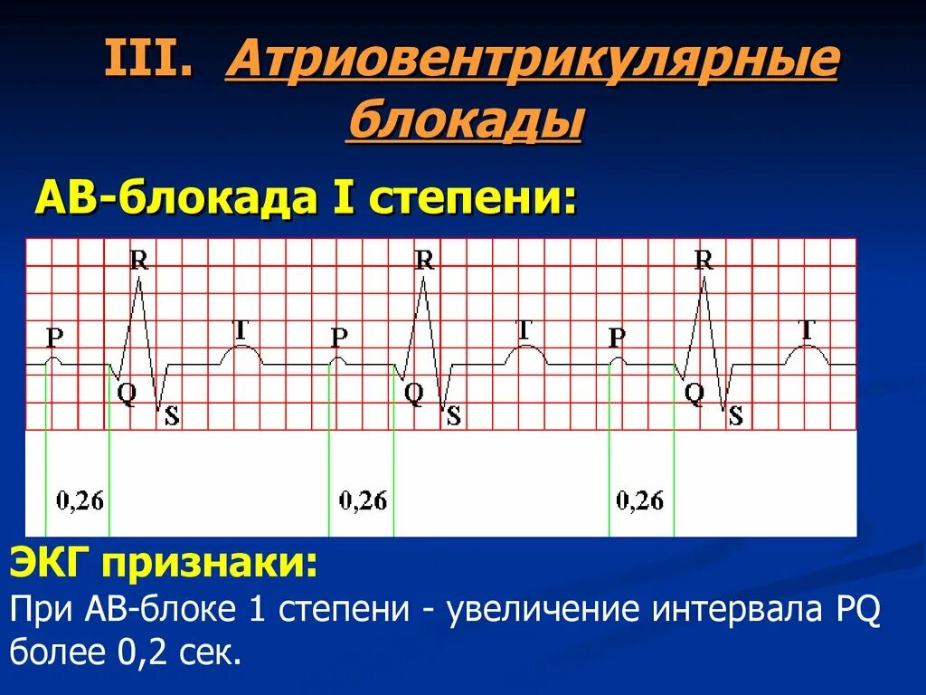 Атриовентрикулярная блокада признаки. Атриовентрикулярная блокада 1 степени. Неполная АВ блокада 1 степени на ЭКГ. Степени атриовентрикулярной блокады на ЭКГ. ЭКГ при атриовентрикулярной блокаде 1 степени.