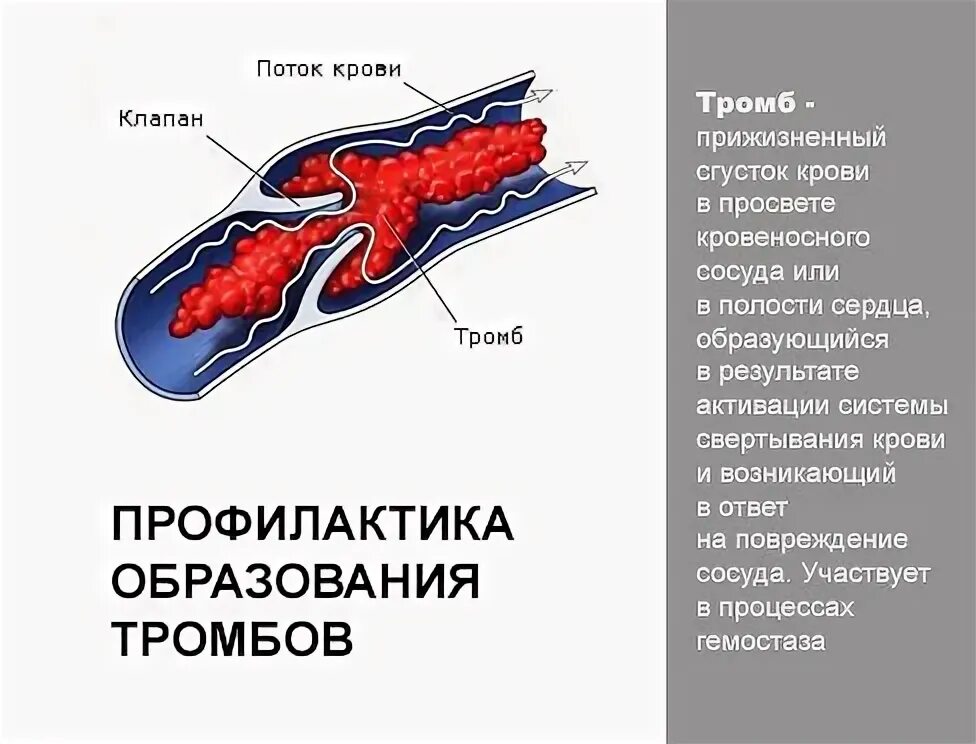 Образование тромбов в крови. Размеры тромбов