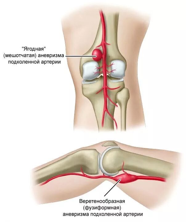 Боль под коленом спереди. Аневризма подколенной вены. Аневризма коленной артерии. Аневризм подколенной артерии. Сустав колена болит сбоку внутренней стороны.