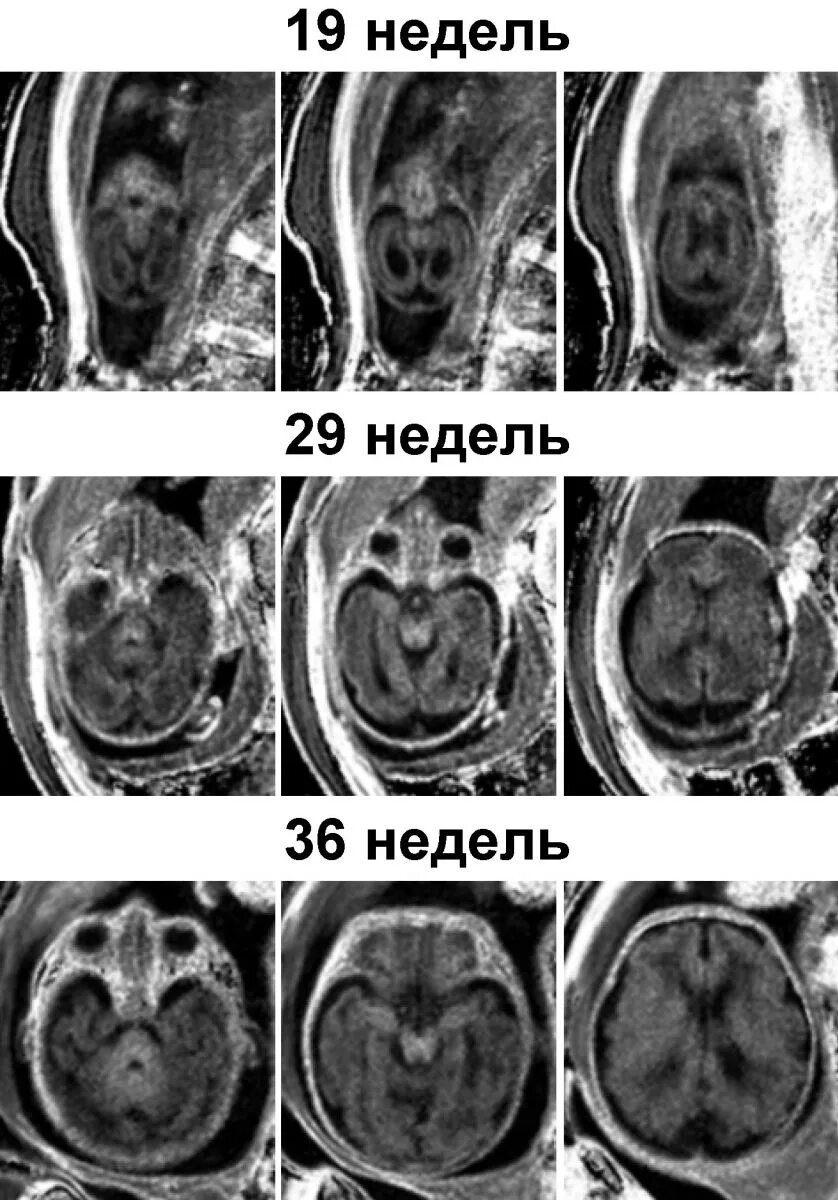 Внутриутробное недоразвитие головного мозга. Мрт ребенка в утробе матери. Формирование мозга эмбриона. Формирование головного мозга внутриутробно.