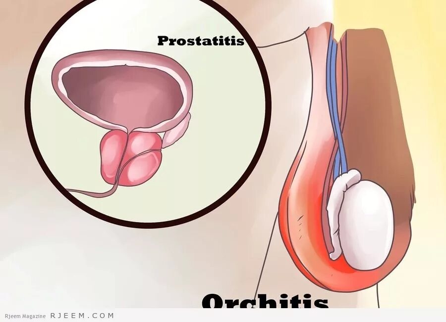 Простатит яиц. Воспаление яичка у мужчин.