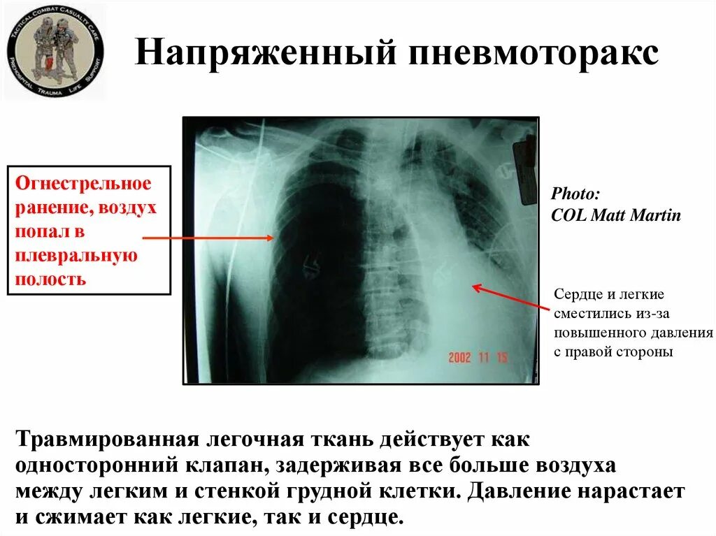 Легкие напряжены. Клапанный пневмоторакс рентген. Спонтанный пневмоторакс рентген. Легкие напряжены. Пневмоторакс при ранении грудной клетки.