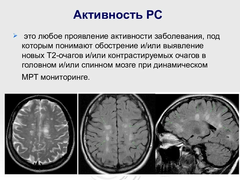 Склероз мозга. Рассеянный склероз демиелинизация. Рассеянный склероз очаги поражения. Очаги рассеянного склероза. Очаги при рассеянном склерозе.