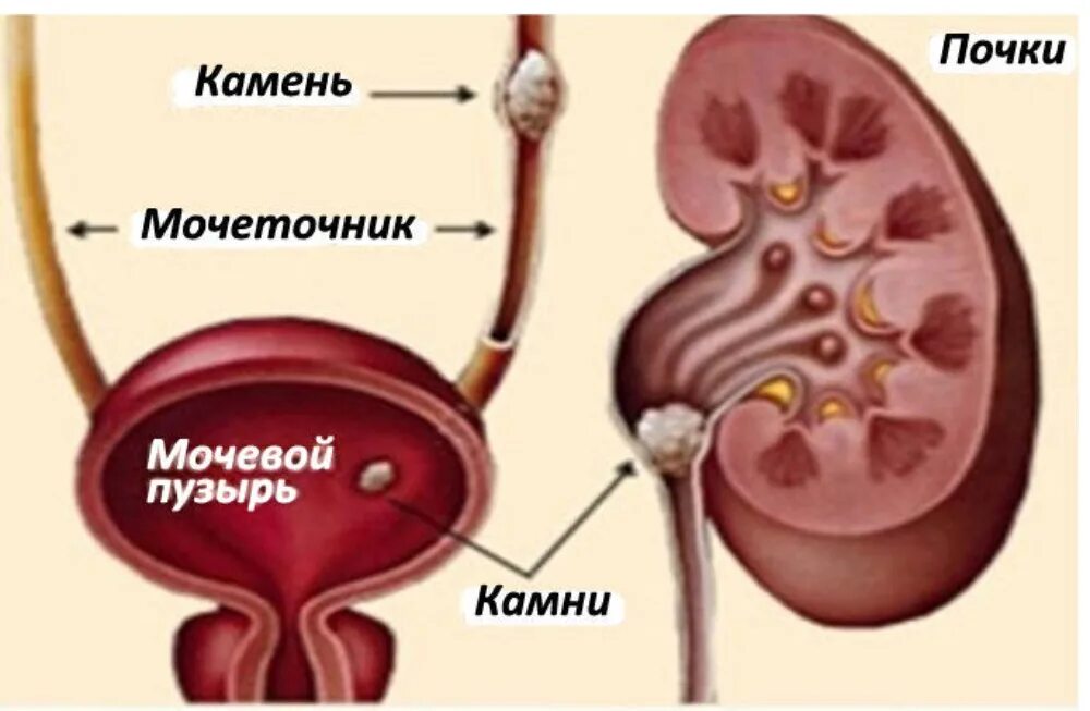 Кровь у мужчины из мочевого. Мочекаменная болезнь камни в мочевом пузыре. Мочевой пузырь при мочекаменной болезни. Мочекаменная болезнь камень мочеточника. Камни в почках мочеточнике и мочевом пузыре.