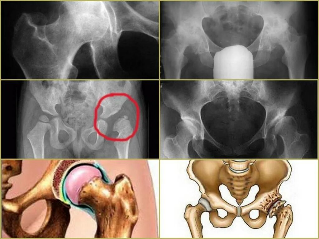 Диспластический коксартроз. Коксартроз тазобедренного 4ст. Коксартроз 2 степени рентген. Коксалгия тазобедренного сустава.