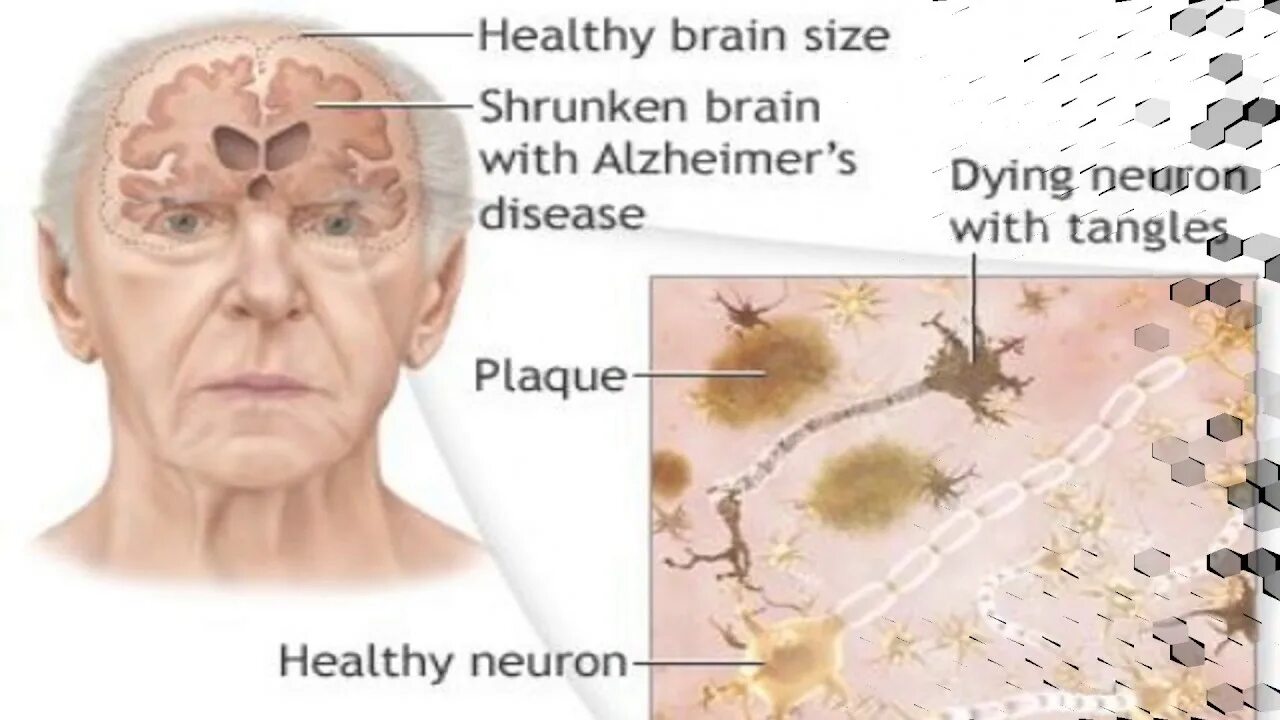 Атрофия головного мозга лечение. Деменция альцгеймеровского типа. Отмирание клеток головного мозга. Симптомы отмирания клеток мозга.
