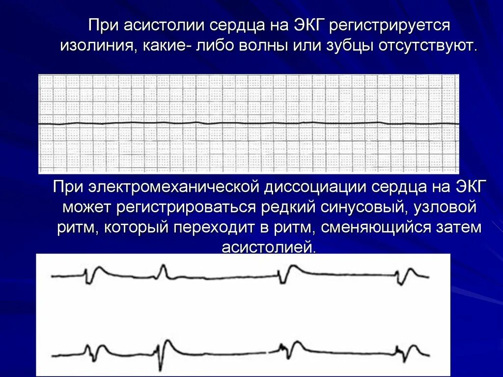 Асистолия что это. Асистолия желудочков на ЭКГ. ЭКГ признаки асистолии желудочков. ЭКГ асистолия и электромеханическая диссоциация. Изоэлектрическая линия на ЭКГ это.