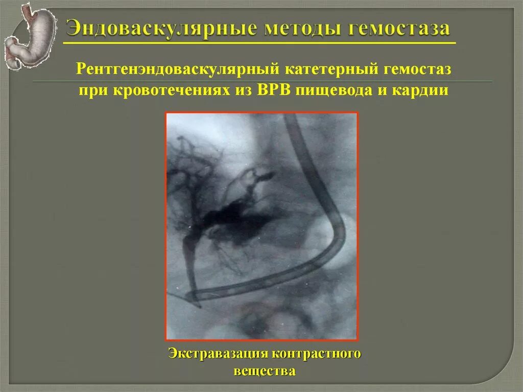 Рентген при желудочно кишечном кровотечении. Эндоваскулярные методы гемостаза. Рентген эндоваскулярная операция. Ангиография желудка при кровотечении.