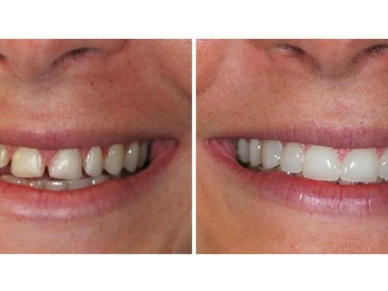 Виниры люминиры компониры. Брекеты резинки для прикуса. Виниры спиливание зубов. На зубы перед тем как. Красивые передние зубы.