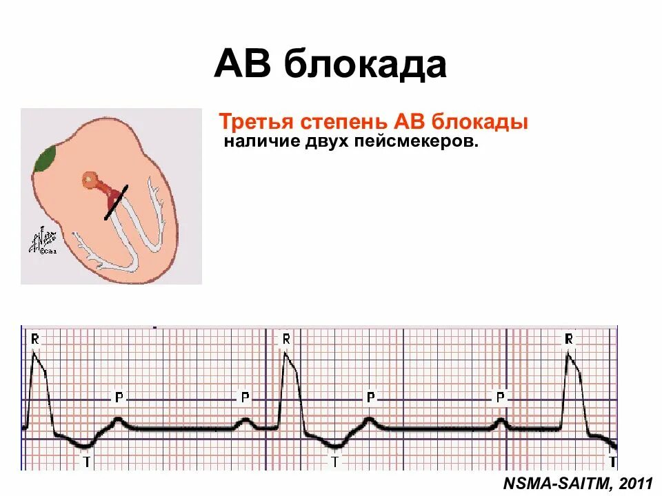 Блокада узла. Полная АВ блокада проксимальный Тип;. АВ блокада 3 степени дистальный Тип. АВ блокада 3 степени проксимальный Тип на ЭКГ. АВ блокада 3 степени проксимальный и дистальный.