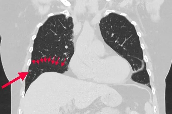 очаг фиброза в легком на кт. классификация очагов в легких. субплевральные очаги кт. кт легких очаги субплевральные заключение. одиночный метастаз в легком рентген.