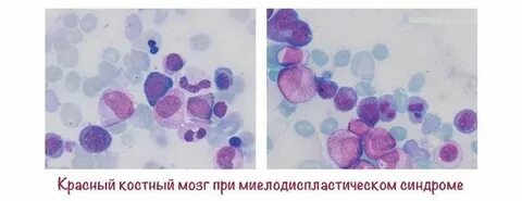 Миелодиспластические синдромы рекомендации