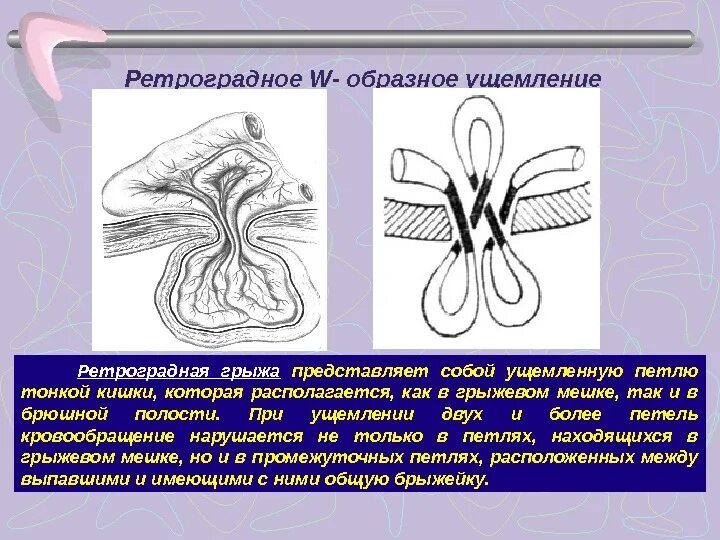 Вправление ущемленной грыжи. Ретроградное w образное ущемление. Ретроградное ущемление грыжи. Пристеночное Рихтеровское ущемление грыжи. Эластическое ущемление грыжи.