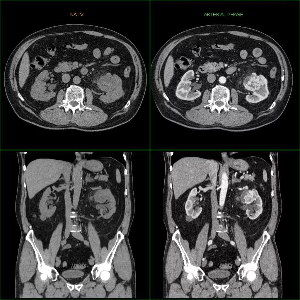 Разница кт и кт с контрастом. Мультиспиральная кт почек опухоль. Кт забрюшинного пространства (почки и надпочечники). Кт с контрастированием опухоль почки. Кт почек с контрастированием норма.