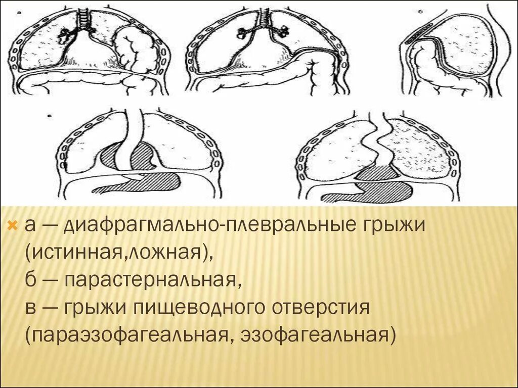 Ущемление грыжи диафрагмы. Диафрагмально плевральные грыжи.