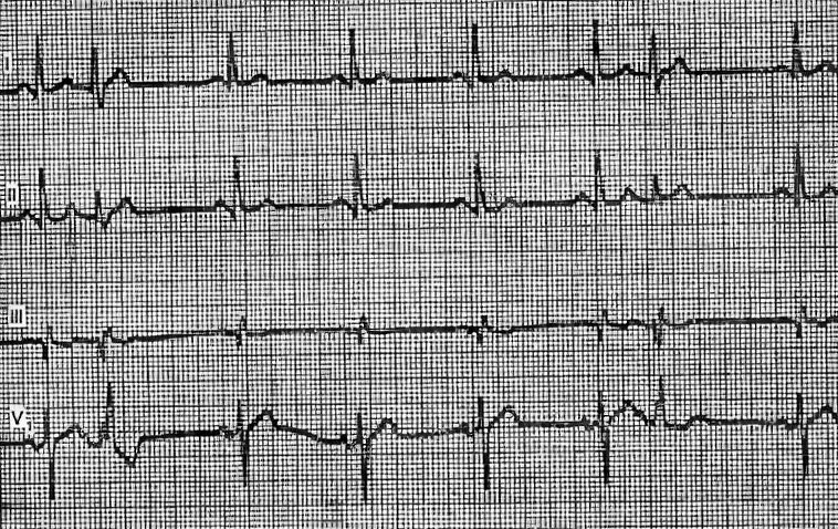 Аберрантный комплекс QRS. Аберрантная наджелудочковая экстрасистолия. Аберрантные экстрасистолы на ЭКГ. Аберрантная предсердная экстрасистола. Аберрантные экстрасистолы