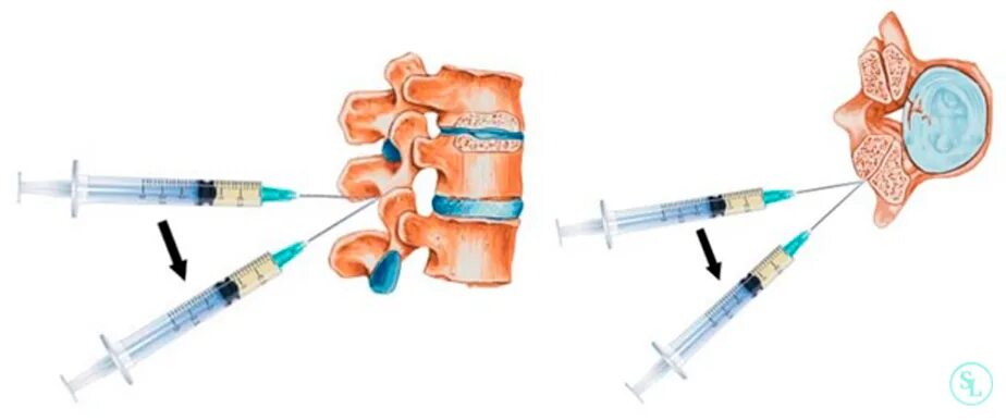 Уколы блокада для спины. Паравертебральная блокада позвоночника. Блокада новокаиновая поясничного отдела крестцового. Игла для блокады грыжи позвоночника. Препараты для блокады грыжи поясничного отдела.